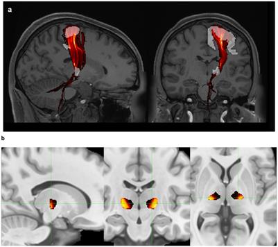 “Quality over quantity:” smaller, targeted lesions optimize quality of life outcomes after MR-guided focused ultrasound thalamotomy for essential tremor